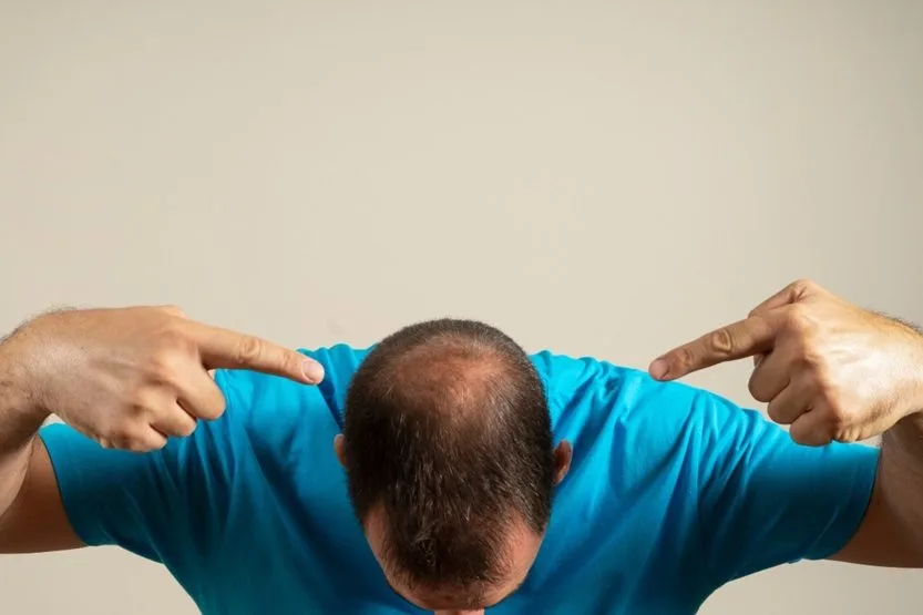Lee más sobre el artículo Alopecia y calvicie: recupera tu confianza con tratamientos naturales
