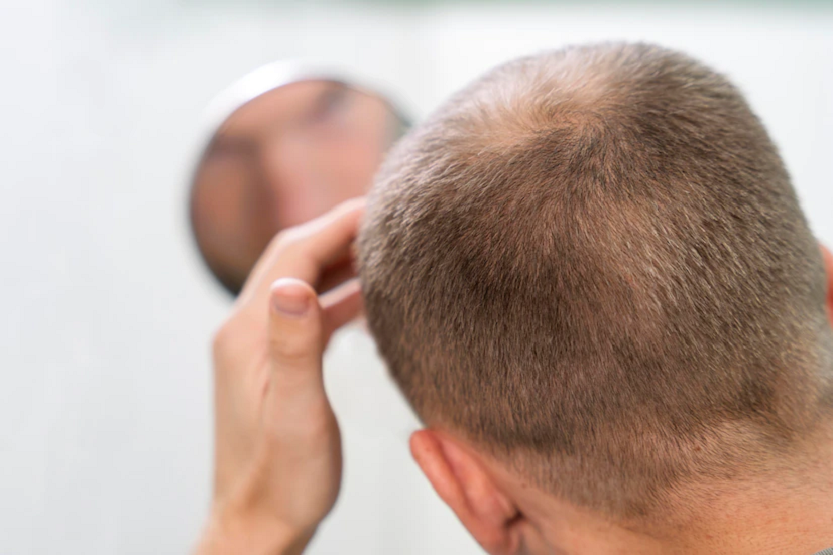 Lee más sobre el artículo ¿Se puede prevenir la caída del cabello en otoño?