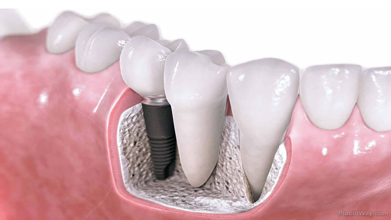 Imagen: sección de mandíbula con implante dental