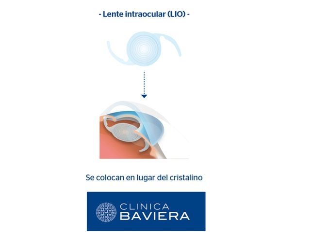 Lentes intraoculares multifocales Clínica Baviera